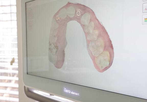 Digital impressions of bite used for treatment planning