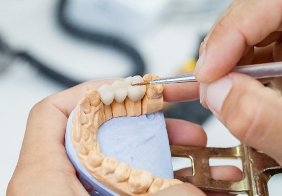 a dental lab technician making a dental bridge