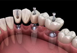 a computer illustration of an implant bridge