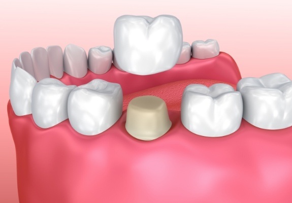 Animated smile during dental crown placement