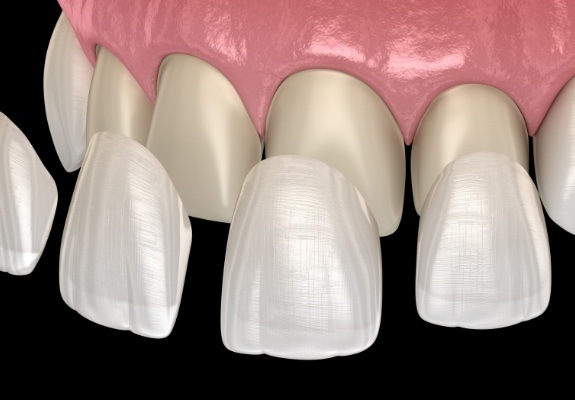 Animated smile during porcelain veneers placement