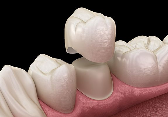 a digital illustration of a dental crown in Lewisville