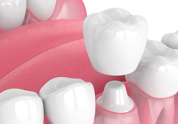 Render of a dental crown in Lewisville, TX being placed