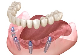 an illustration of implant dentures in Lewisville