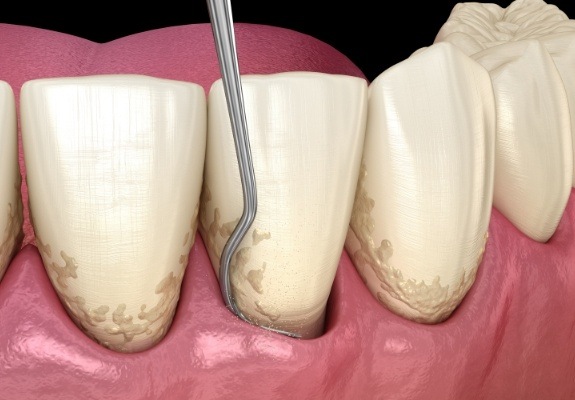 Animated smile during scaling and root planing