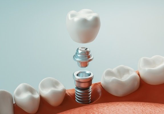 Animated smile during the four step dental implant process