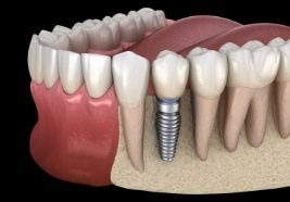 Animated smile during dental implant supported dental crown placement