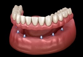 Animated smile during dental implant supported denture placement