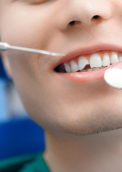 A man with a chipped tooth