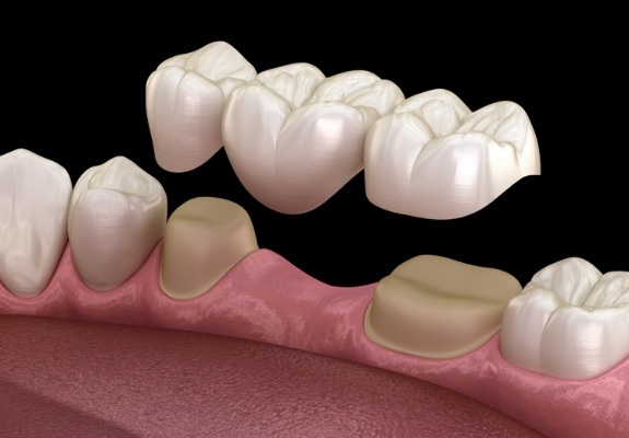 Animated smile with dental bridge restoration