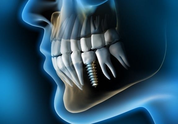 Animated smile with dental implant supported dental crown