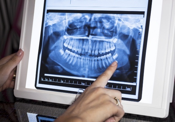 Dental team member pointing to digital x-rays