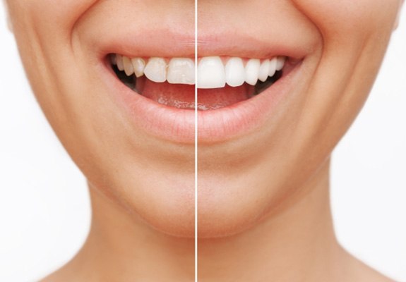 Closeup of woman's smile before and after veneers