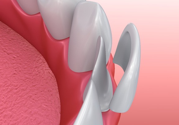 Illustration of veneer being placed on lower front tooth