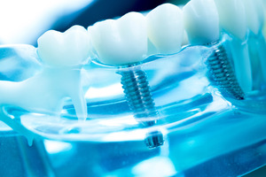 Two dental implants and a bridge in a plastic tray
