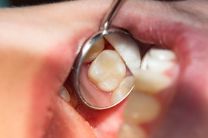 Examining a tooth that has received a filling