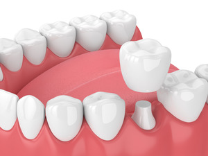 3D render of a dental crown