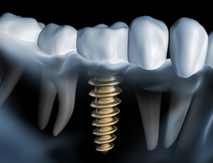 3D model of a dental implant