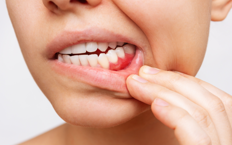 Close up of woman's mouth with inflamed gums